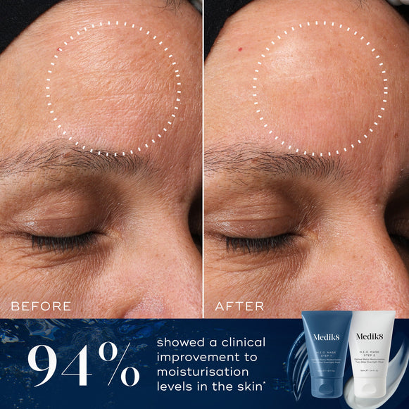 A before and after close-up comparison of a forehead, showing visibly smoother and more hydrated-looking skin in the circled area on the "After" side compared to the "Before" side. Text below states "94% showed a clinical improvement to moisturisation levels in the skin*". Tubes of Medik8 H.E.O. Mask Step 1 and Step 2 are displayed in the corner against a blue background.-hover-6