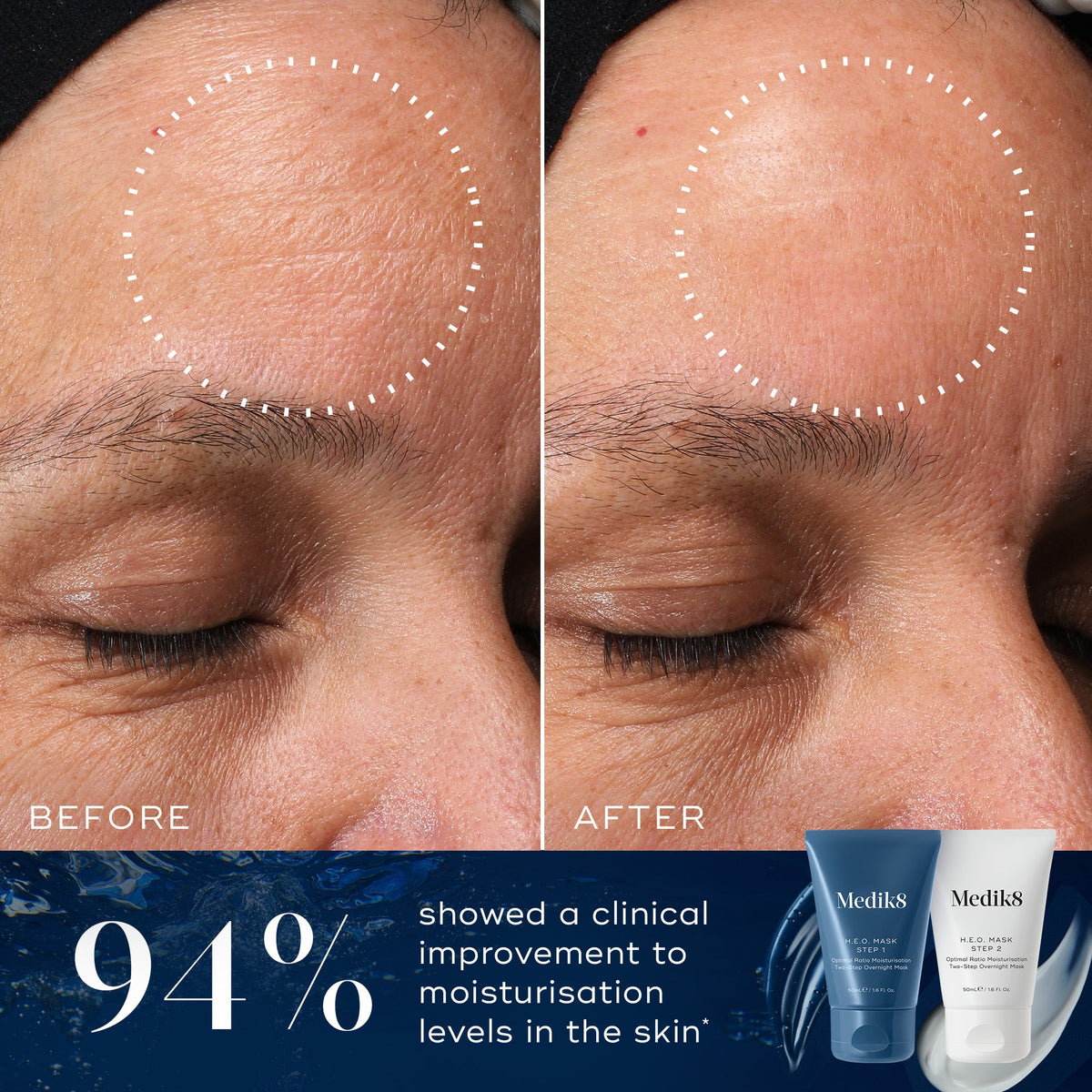 A before and after close-up comparison of a forehead, showing visibly smoother and more hydrated-looking skin in the circled area on the "After" side compared to the "Before" side. Text below states "94% showed a clinical improvement to moisturisation levels in the skin*". Tubes of Medik8 H.E.O. Mask Step 1 and Step 2 are displayed in the corner against a blue background.