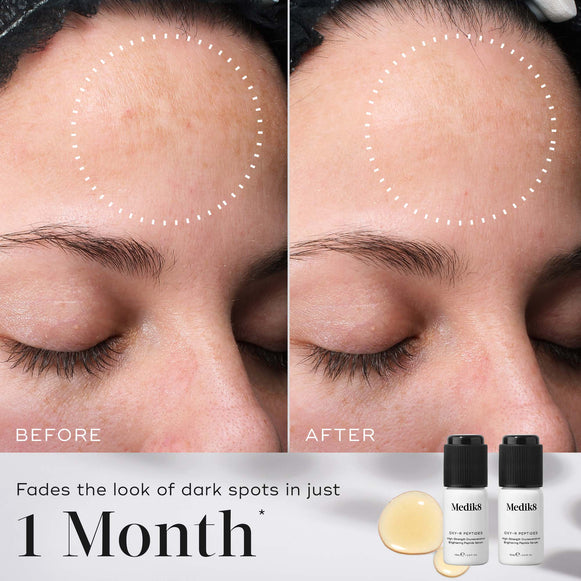 A before-and-after comparison of a person's forehead shows faded dark spots. Dotted white circles highlight the areas of change. Below the images, text states Fades the look of dark spots in just 1 Month. -hover-17
