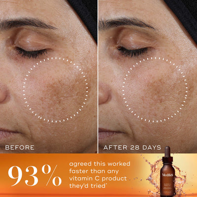 A side-by-side  Before  and  After 28 Days  comparison of a person's cheek and eye area. A white dashed circle highlights a reduction in the appearance of dark spots and uneven pigmentation in the  After  image. A bold orange banner at the bottom features the statement:  93% agreed this worked faster than any vitamin C product they'd tried* . The Super C Ferulic serum bottle is shown in the bottom right corner against a splashing amber liquid background.