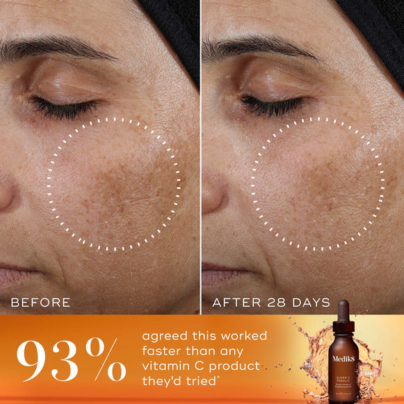 A side-by-side  Before  and  After 28 Days  comparison of a person's cheek and eye area. A white dashed circle highlights a reduction in the appearance of dark spots and uneven pigmentation in the  After  image. A bold orange banner at the bottom features the statement:  93% agreed this worked faster than any vitamin C product they'd tried* . The Super C Ferulic serum bottle is shown in the bottom right corner against a splashing amber liquid background.-hover-18