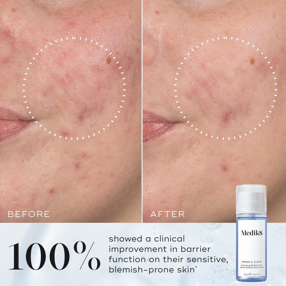 Side-by-side comparison labelled  Before  and  After  showing reduced redness and clearer skin inside a dotted circle. Text states  96% showed a clinical improvement in barrier function on their sensitive, blemish-prone skin* .