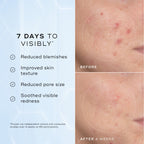 A split image showing a close-up of skin texture labelled "Before" and "After 4 Weeks," highlighting improvements. Text on the left lists benefits: "Reduced blemishes," "Improved skin texture," "Reduced pore size," and "Soothed visible redness."